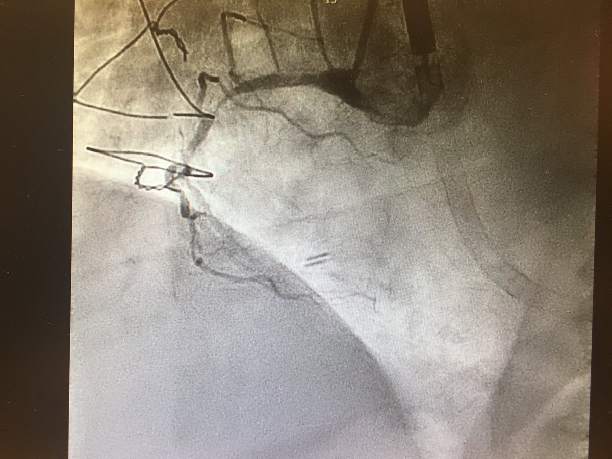 oriolrodriguez5's tweet image. #CHIPcase 74yo male, LM+3vd, LVEF 17%, previous non-functionant CABG. Previous inferior MI without inferior viability. Actual NSTEMI with cardiogenic shock. Sent to our centre for Complex PCI @foroic @belcid7 @sbrugaletta @mmamas1973 @shci_sec @jedicath @hect2701 @Xavi_Carrillo7