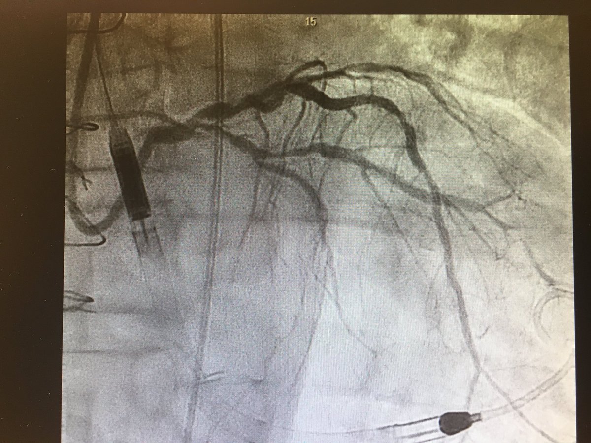 oriolrodriguez5's tweet image. #CHIPcase 74yo male, LM+3vd, LVEF 17%, previous non-functionant CABG. Previous inferior MI without inferior viability. Actual NSTEMI with cardiogenic shock. Sent to our centre for Complex PCI @foroic @belcid7 @sbrugaletta @mmamas1973 @shci_sec @jedicath @hect2701 @Xavi_Carrillo7