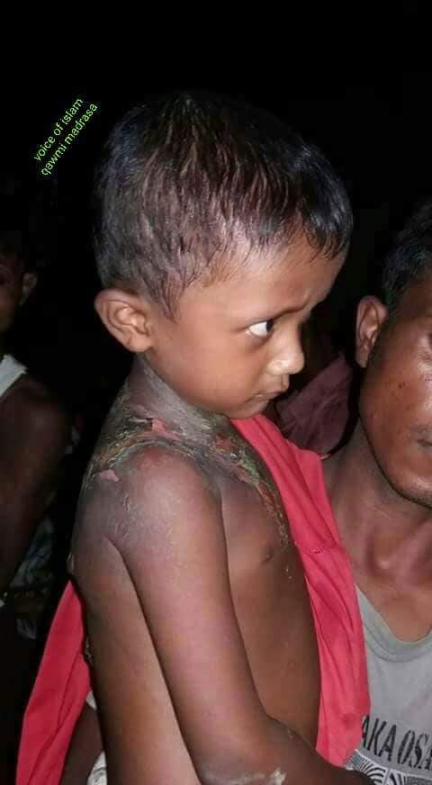 Jhoncarry15's tweet photo. မီးပုံထဲသုိ႕ခုန္ခ်တယ္လုိ႕ေျပာမလား?????????

သူ႕ေက်ာျပင္တစ္ခုလုံးမီးေလာင္ခဲ႕တာပါ

မီးပုံထဲသုိ႕ပစ္ခ်တယ္လုိ႕ေျပာပါတယ္၊ကံေကာင္းလုိ႕ေပါ႕

ရက္စက္လုိက္တာေနာ္၊ဗုဒၶေတာင္ခြင္႕လြွတ္မယ္မထင္ပါ https://t.co/zyqjLW2uTo