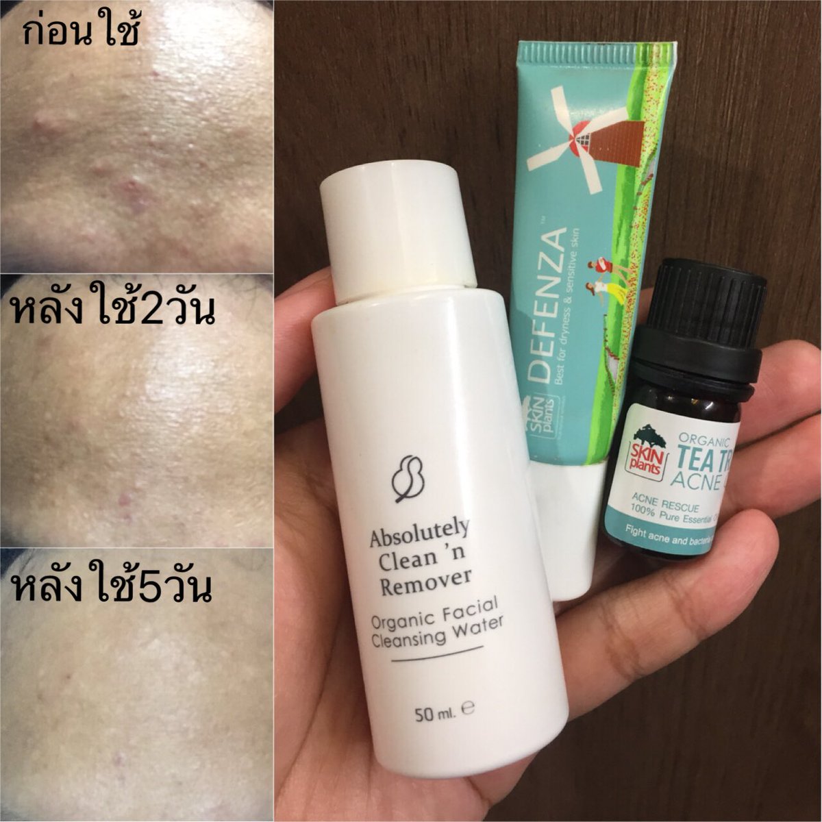 jarevieww's tweet photo. สวยกว่านี้ก็นางฟ้า ไม่พูดเยอะเจ็บคอ ยี่ห้อ skinplants ดังขนาดไหนไม่รู้ แต่รู้ว่าผลลัพธ์ชัดเจนจริง ผิวเนียนขึ้น สิวผดกับอุดตันน้อยลง สิวอักเสบยุบไว 3อันราคาแค่ 750฿ ซื้อจากร้านโป๊ะผักวังหลัง #จะรีวิว #ใช้เองรีวิวเอง #ไว้รีวิวห้ามขายของโว๊ยย https://t.co/4xdPikCxQv