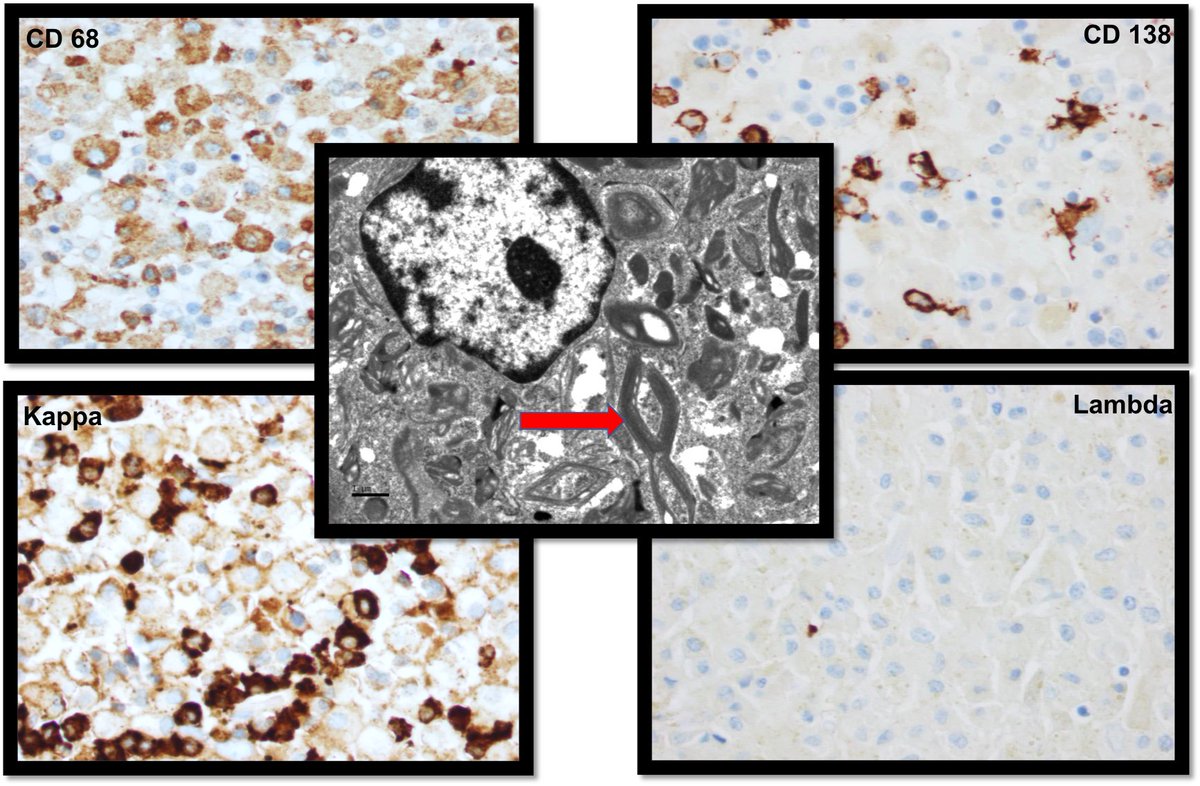 TexPathol's tweet photo. CD138 + monoclonal PC’s. EM: rhomboid crystals. Dx: Crystal storing histiocytosis, multiple myeloma. Crystalline material in non-neoplastic proliferating histiocytes. Assoc. w/ lymphoproliferative neoplasms. Look for the hidden PC’s! #Hemepath
#TSPchallenge @JaitlyVanya https://t.co/LM2m8HUfTZ