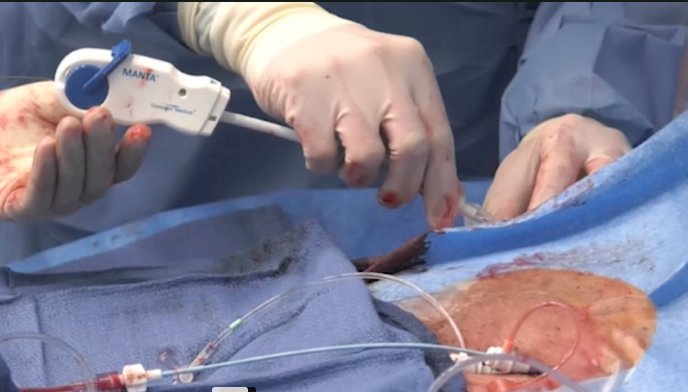 DAICeditor's tweet photo. VIDEO: How to Achieve #Hemostasis With Large Bore Device Access at #TCT2018
https://t.co/GkQhLo1cjGโฆ/video-how-achieve-hemostasisโฆ
@philgenereux, M.D., Gagnon Cardiovascular Institute, explains how to close large access sites from #TAVR, #TEVAR, #Hemodynamicsupport https://t.co/ty1zWliwj0