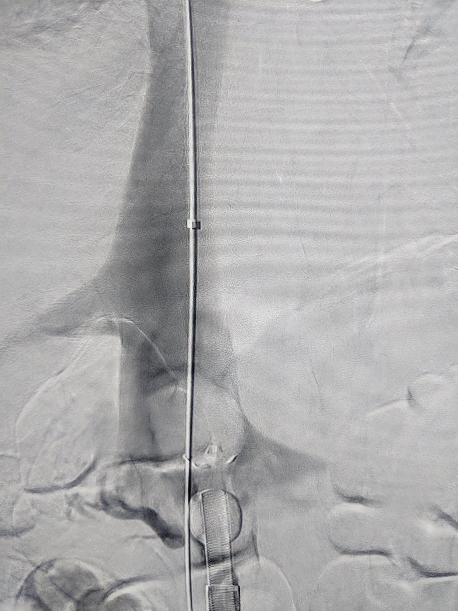 VIRDelaware's tweet photo. Aspiration thrombectomy @VIRDelaware part 2: large thrombus in IVC and RV on TEE. Dragged 2 IVC with AngioVac but 2 big 2 be removed. Placed suprarenal filter which caught 1/2 of the thrombus after cutting it with a snare. More angiovac in filter. Good final result. #IRAD @SIRRFS https://t.co/4a2SNXz0NL