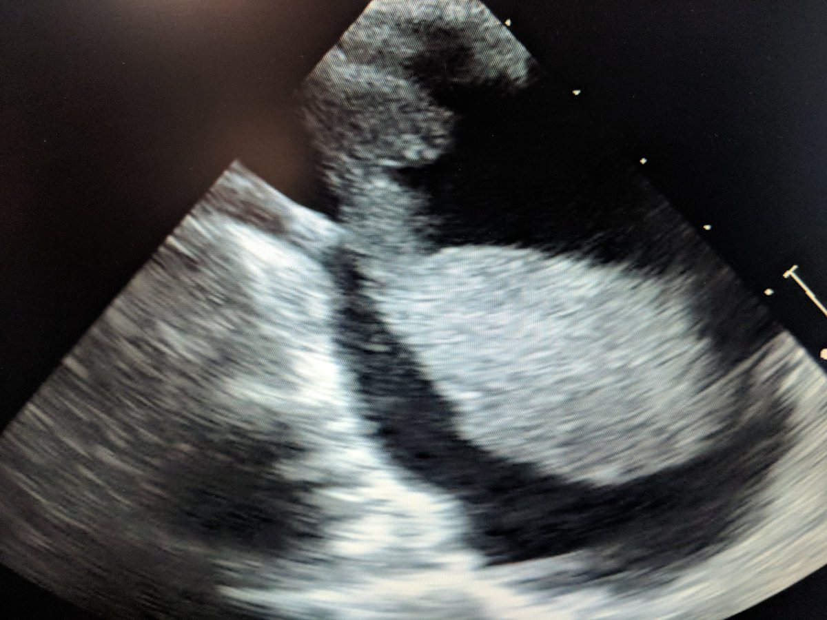 VIRDelaware's tweet photo. Aspiration thrombectomy @VIRDelaware part 2: large thrombus in IVC and RV on TEE. Dragged 2 IVC with AngioVac but 2 big 2 be removed. Placed suprarenal filter which caught 1/2 of the thrombus after cutting it with a snare. More angiovac in filter. Good final result. #IRAD @SIRRFS https://t.co/4a2SNXz0NL