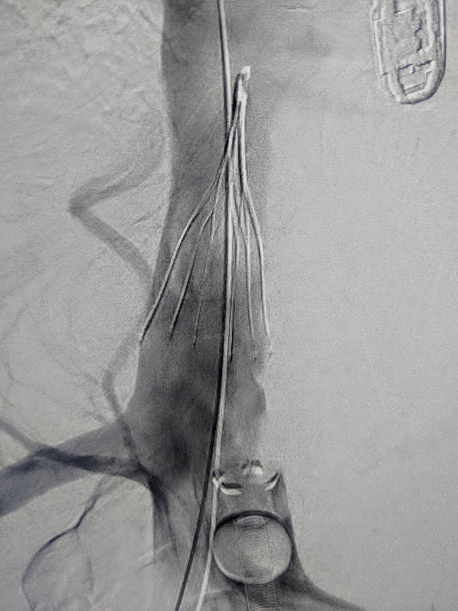 VIRDelaware's tweet photo. Aspiration thrombectomy @VIRDelaware part 2: large thrombus in IVC and RV on TEE. Dragged 2 IVC with AngioVac but 2 big 2 be removed. Placed suprarenal filter which caught 1/2 of the thrombus after cutting it with a snare. More angiovac in filter. Good final result. #IRAD @SIRRFS https://t.co/4a2SNXz0NL
