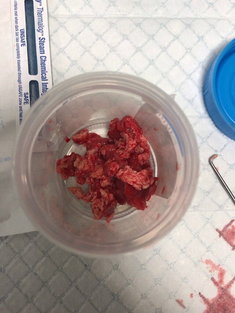 VIRDelaware's tweet photo. Aspiration thrombectomy @VIRDelaware part 2: large thrombus in IVC and RV on TEE. Dragged 2 IVC with AngioVac but 2 big 2 be removed. Placed suprarenal filter which caught 1/2 of the thrombus after cutting it with a snare. More angiovac in filter. Good final result. #IRAD @SIRRFS https://t.co/4a2SNXz0NL