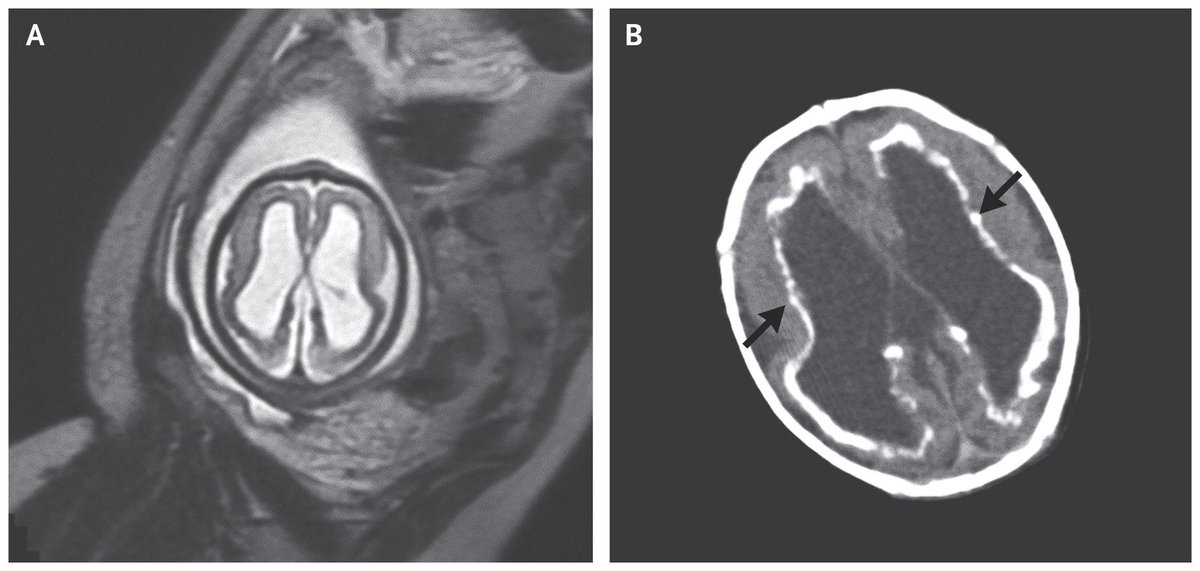 NEJM's tweet photo. Images in Clinical Medicine: Congenital Cytomegalovirus Infection https://t.co/WrSAluA861 https://t.co/3MdHGyGkfs