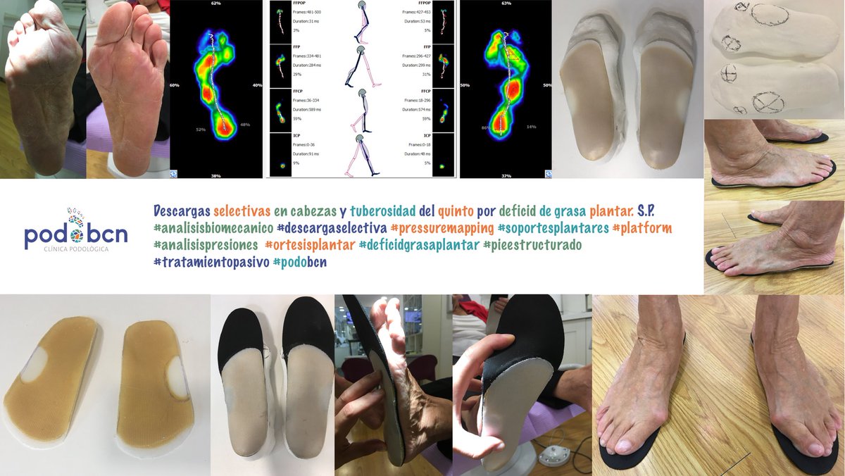 PODOBCN's tweet photo. Descargas selectivas en cabezas y tuberosidad del quinto por deficid de grasa plantar. S.P.
#analisisbiomecanico #descargaselectiva #pressuremapping #soportesplantares #platform #analisispresiones  #ortesisplantar #deficidgrasaplantar #pieestructurado #tratamientopasivo #podobcn https://t.co/WuuDKoBxCU