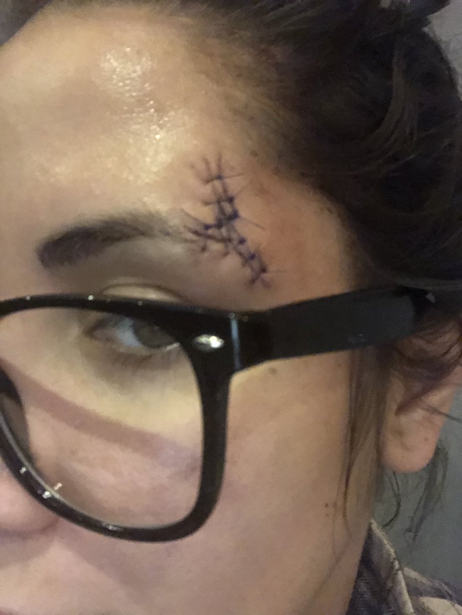 taniaz_ca's tweet photo. So I fell and hit my counter resulting in a concussion and 8 stitches. I’m lucky I wasn’t hurt even worse, but I am quite unhappy with this butcher job the DR did to my face after SHAVING half of my eyebrow off. #besidemyself #disappointed #ouch https://t.co/nR9rmGtfx8