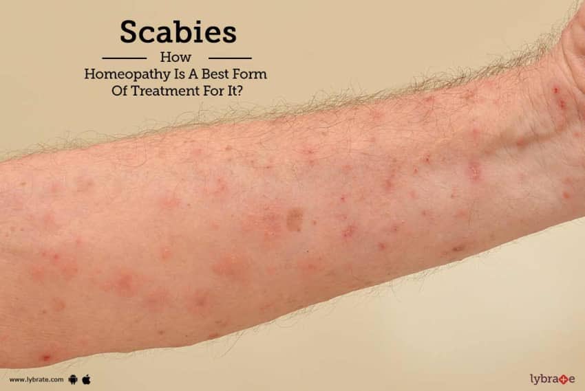 5-Scabies(الجرب)*Transmission:by Mites (person to person contact)or (use co...