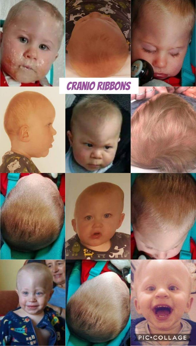 CranioRibbons's tweet photo. Metopic Craniosynostosis
#Craniosynostosis #cranioribbons #cranioribbonsireland #September #awareness #warriors #sutures #metopic #sagittal #coronal #lambdoid https://t.co/Nix3rEzBUH