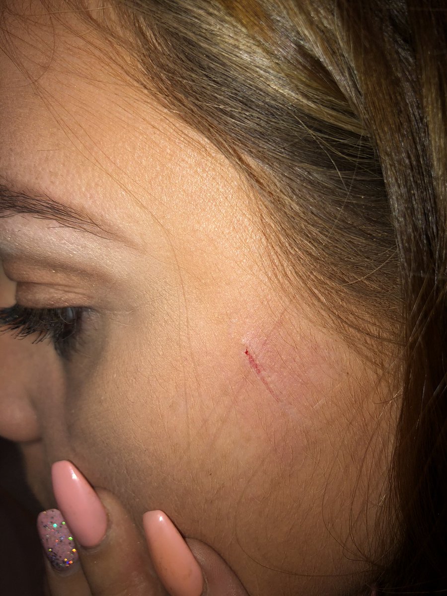 lizeagleh's tweet photo. Can’t believe this has just happened, mid doing my makeup with my @ICONICLDN brush set and it physically snaps and cuts my face. Been a big customer of theirs for a while and never expected this!! #iconiclondon #nothappy #becarefulgirls https://t.co/Job1RNHKH8