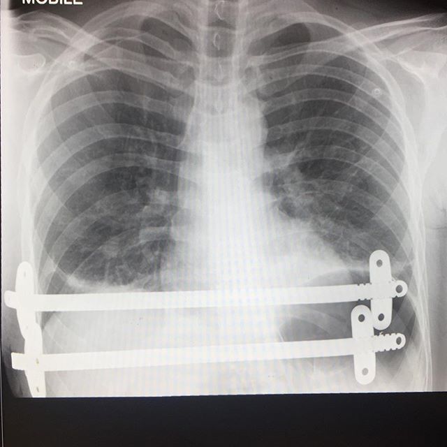 CTFLeics's tweet photo. Spending the weekend visiting a friend in hospital. He’s got an interesting x-ray and has give permission for it to be shared. Can anyone name the procedure performed? Why is it commonly performed? #weekendtrips #visitingtime #unifriends #weekend quiz #c… https://t.co/UapeMLei4X https://t.co/XaQ50UbO54