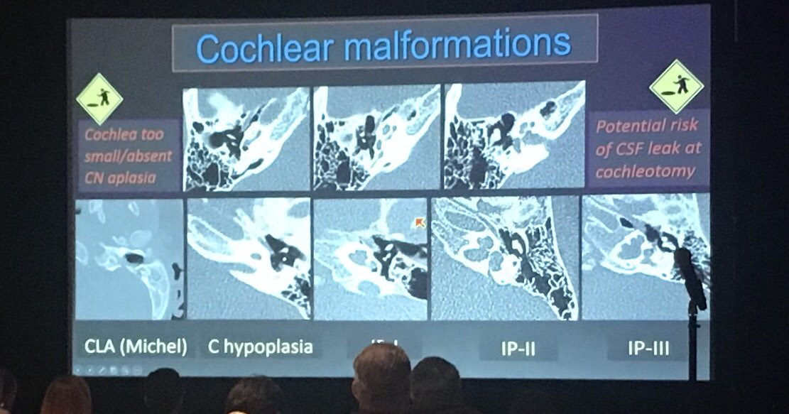 Cochlear malformations made easy to understand by Dr. Robson at #ASHNR18 #pedineurorad #temporalbone