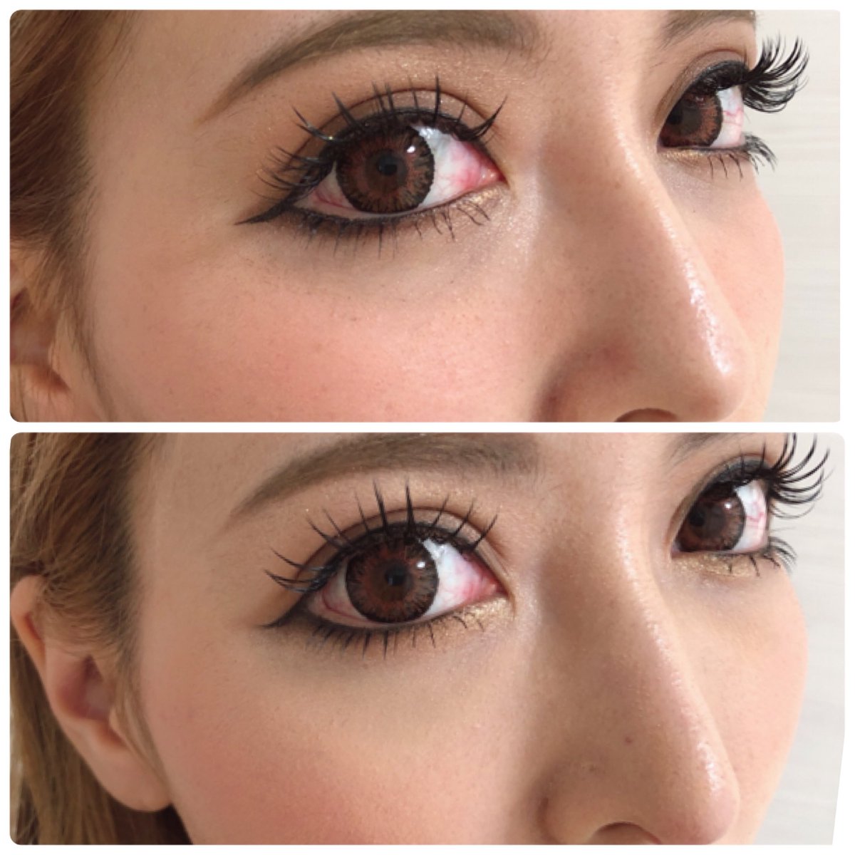 吉川 ちか 脂肪注入の比較画像 上 整形前 下 目の下脂肪注入後 ふっくらしてクマが 目立ちにくくなったのと 肌にハリがでて綺麗になった 整形 脂肪注入