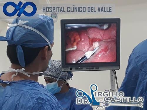 La <a href="/ulapvalle/">Unidad de Laparoscopia y Bariátrica del Valle</a>, Mérida cuenta con un excelente equipo de cirujanos, para realizar su cirugía, así como con equipos de la mejor tecnología de alta definición para darle una visión clara y precisa a los Médicos que realizan la cirugía. 
<a href="/ulapvalle/">Unidad de Laparoscopia y Bariátrica del Valle</a> 
<a href="/drvirgilioc/">Dr Virgilio Castillo</a>
<a href="/virgiliocastill/">Virgilio Castillo B</a>