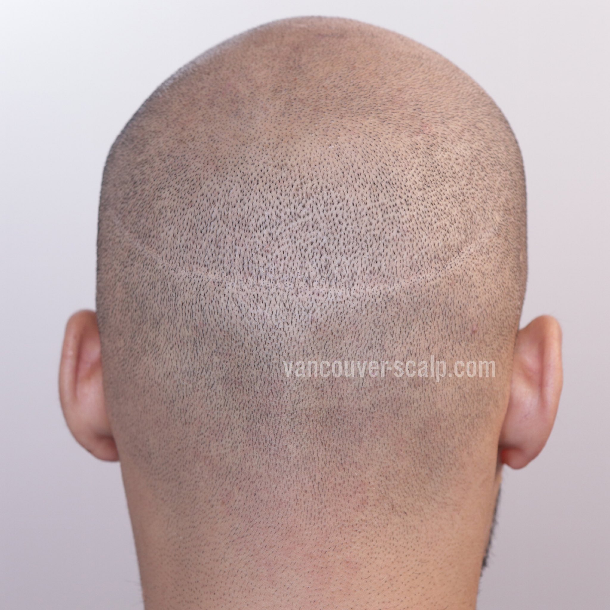 Vancouver Scalp on Twitter: Vancouver Scalp on Twitter: