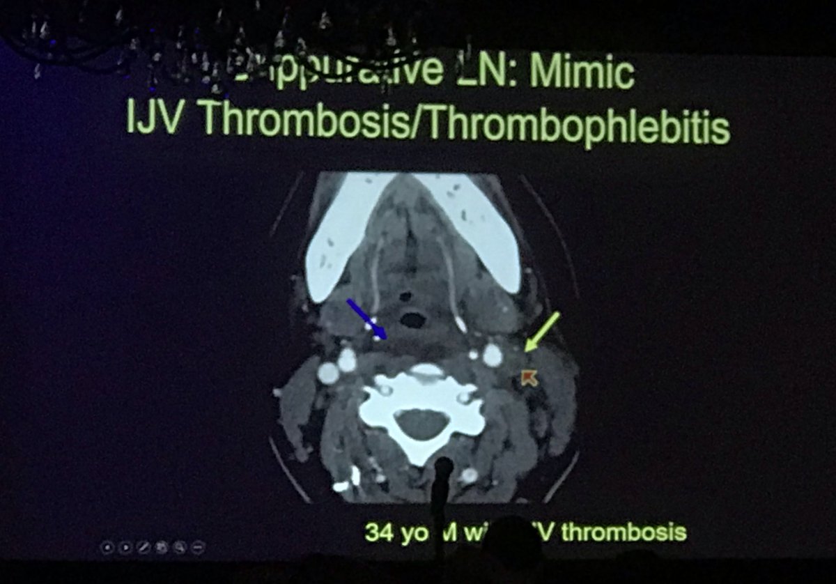 DShatzkes's tweet photo. Sunday morning #PEARL from Karen Salzman. COUNT YOUR VESSELS! If you can count to 4, you’ve ruled out thrombosed IJV as a cause of a rim enhancing neck mass. #ASHNR18 @ASHNRSociety https://t.co/LCbTHtrA7D