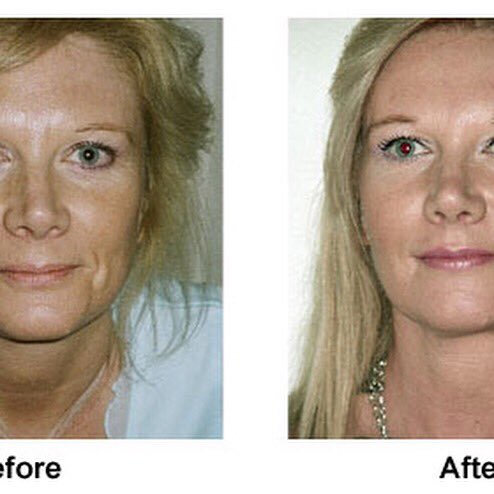 regeniaclinic's tweet photo. LIQUID FACELIFT (SCULPTRA)

A simple injectable volumising treatment that stimulates collagen to smooth out lines and wrinkles and restore lost facial volume to The enhancement is long-lasting(2-3 years) and looks completely natural 

PM or ring 01633 670742 or 07725761767 https://t.co/yZmqtgt2FO