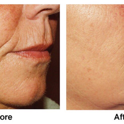 regeniaclinic's tweet photo. LIQUID FACELIFT (SCULPTRA)

A simple injectable volumising treatment that stimulates collagen to smooth out lines and wrinkles and restore lost facial volume to The enhancement is long-lasting(2-3 years) and looks completely natural 

PM or ring 01633 670742 or 07725761767 https://t.co/yZmqtgt2FO