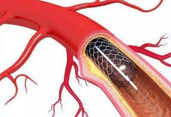 timesofindia's tweet photo. Made in India coronary stents as good as foreign ones: Study 

https://t.co/GYeZ82v3ic https://t.co/zEu5gIYRCS