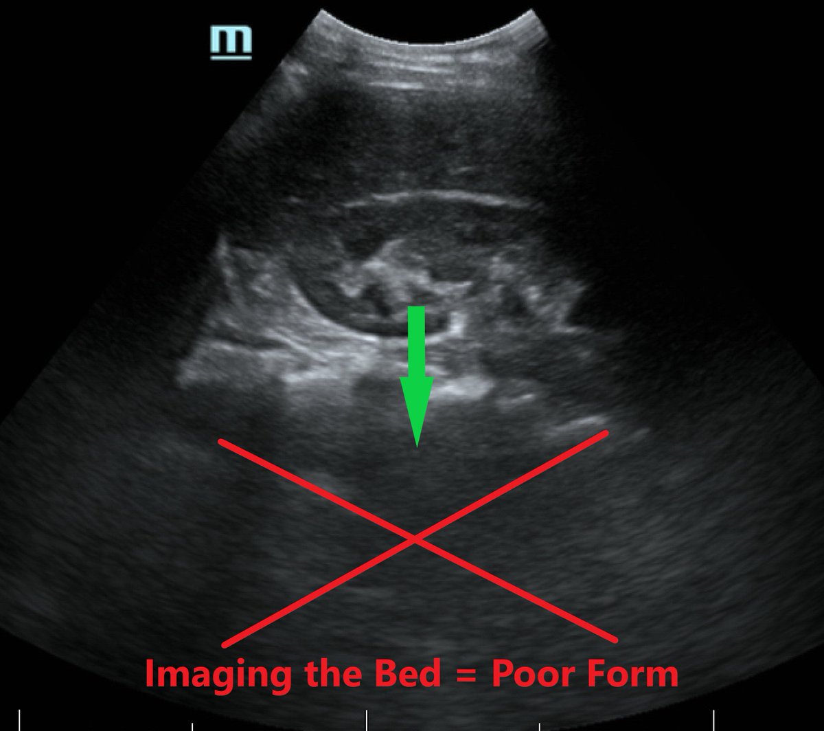 SonoMojo's tweet photo. #SonoProTip Technique: Going Too Deep
Every time you use too much depth a kitten dies... and you hurt your image quality big time! Goal = structure in middle of screen #FOAMus #FOAMed More details at https://t.co/g30EJVfwUB https://t.co/UredUvgPAG