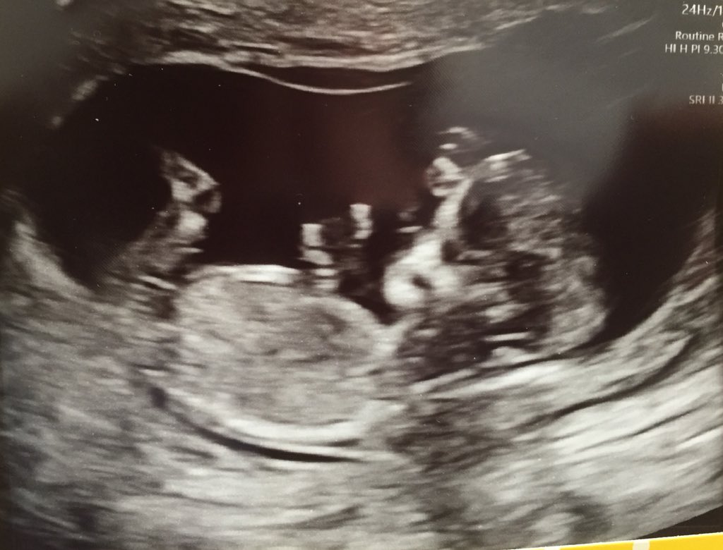 DoveEmma's tweet photo. New member of Team Dove expected to make an appearance April 2019. Science is bloody amazing! #IVF #DonorBaby #LittleFrostie #FET #SpermDonor https://t.co/Abu4T69YeW