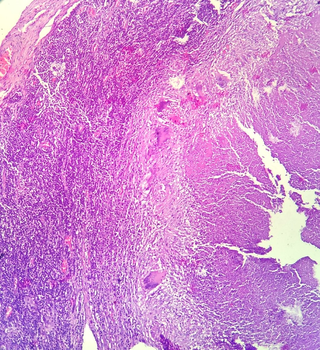 DrNishatAfroz2's tweet photo. O how beautiful r these necrotising granulomas typical of MTB wit intact CMI. cervical lymph node 20 yr male.#Pathology #Histopathology #humanPathology https://t.co/mvWsxFvZQ1