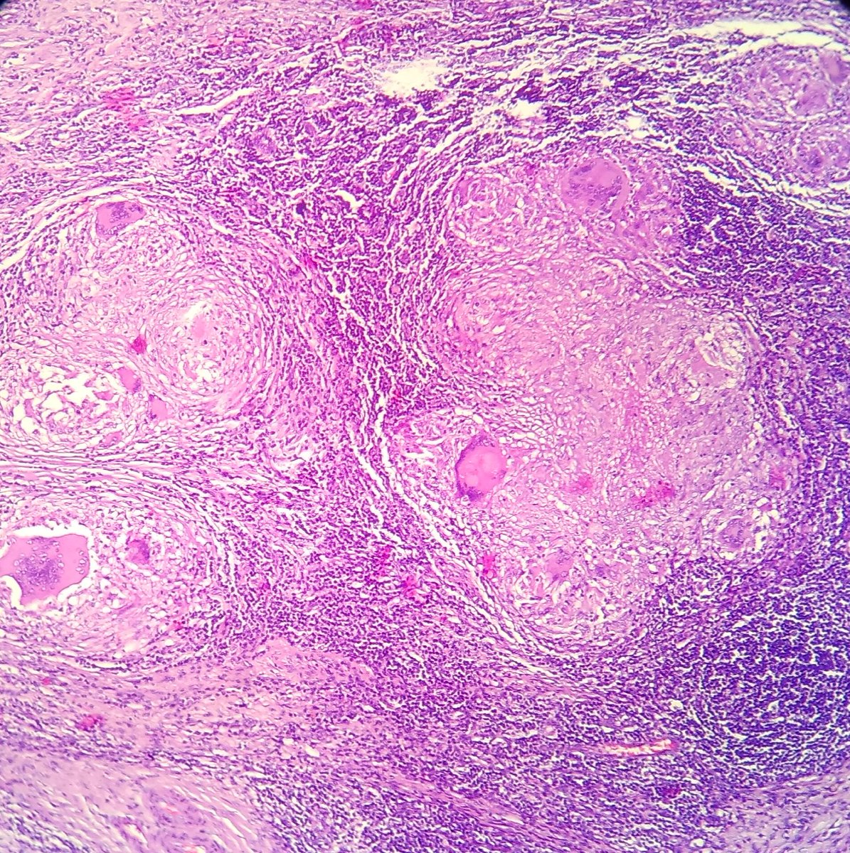 DrNishatAfroz2's tweet photo. O how beautiful r these necrotising granulomas typical of MTB wit intact CMI. cervical lymph node 20 yr male.#Pathology #Histopathology #humanPathology https://t.co/mvWsxFvZQ1