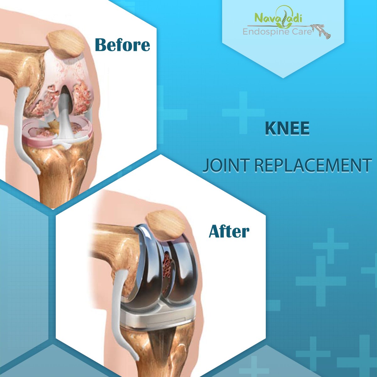 Joint replacement surgery is a safe and effective procedure to relieve pain, correct leg deformity, and help you resume normal activities.

Visit us: navaladiendospinecare.com

#jointreplacement
#knee
#pain