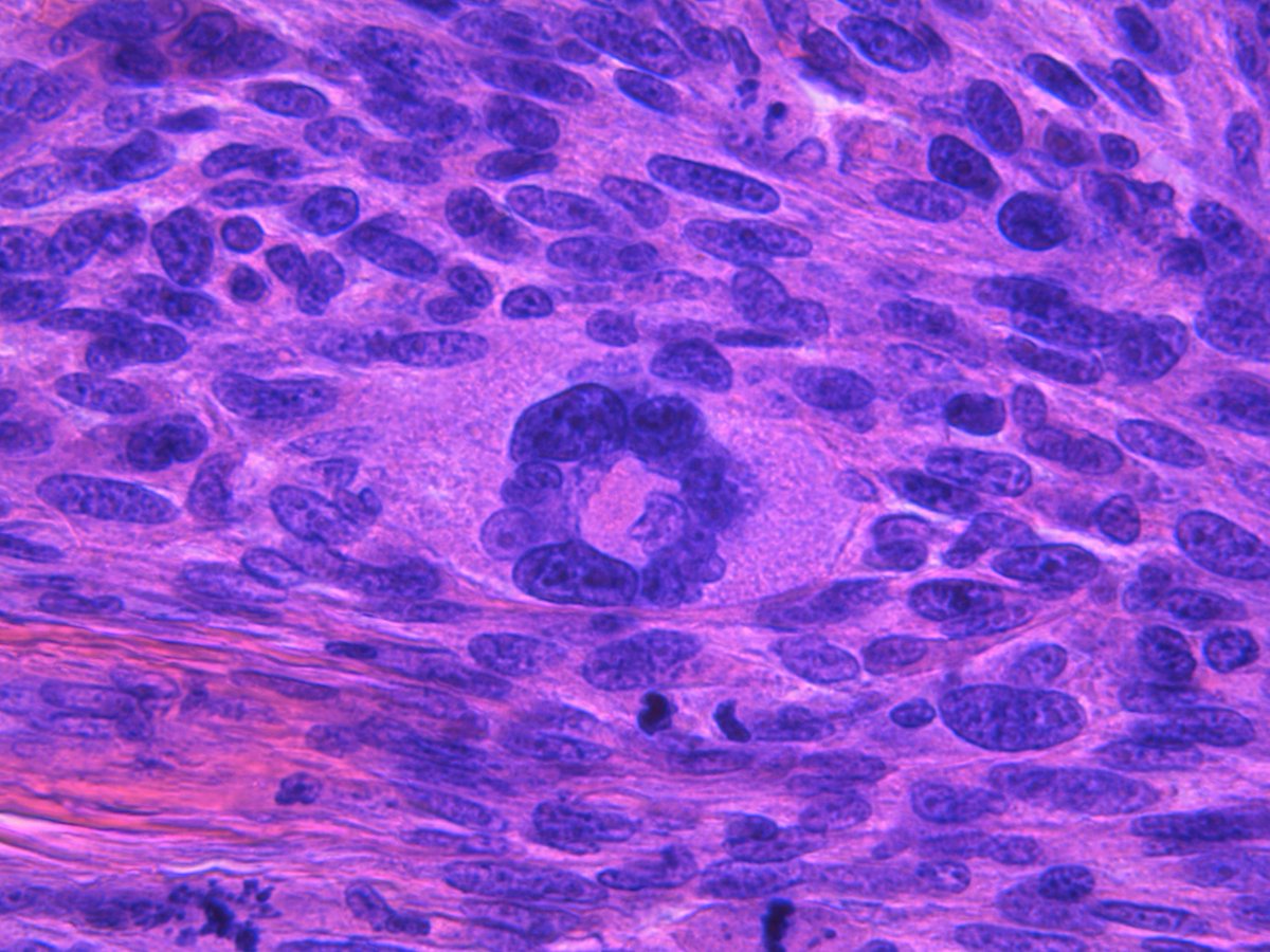 Patholwalker's tweet image. Leiomyosarcoma. Soft tissue, resection. HE and Caldesmon. #pathology #BSTpath