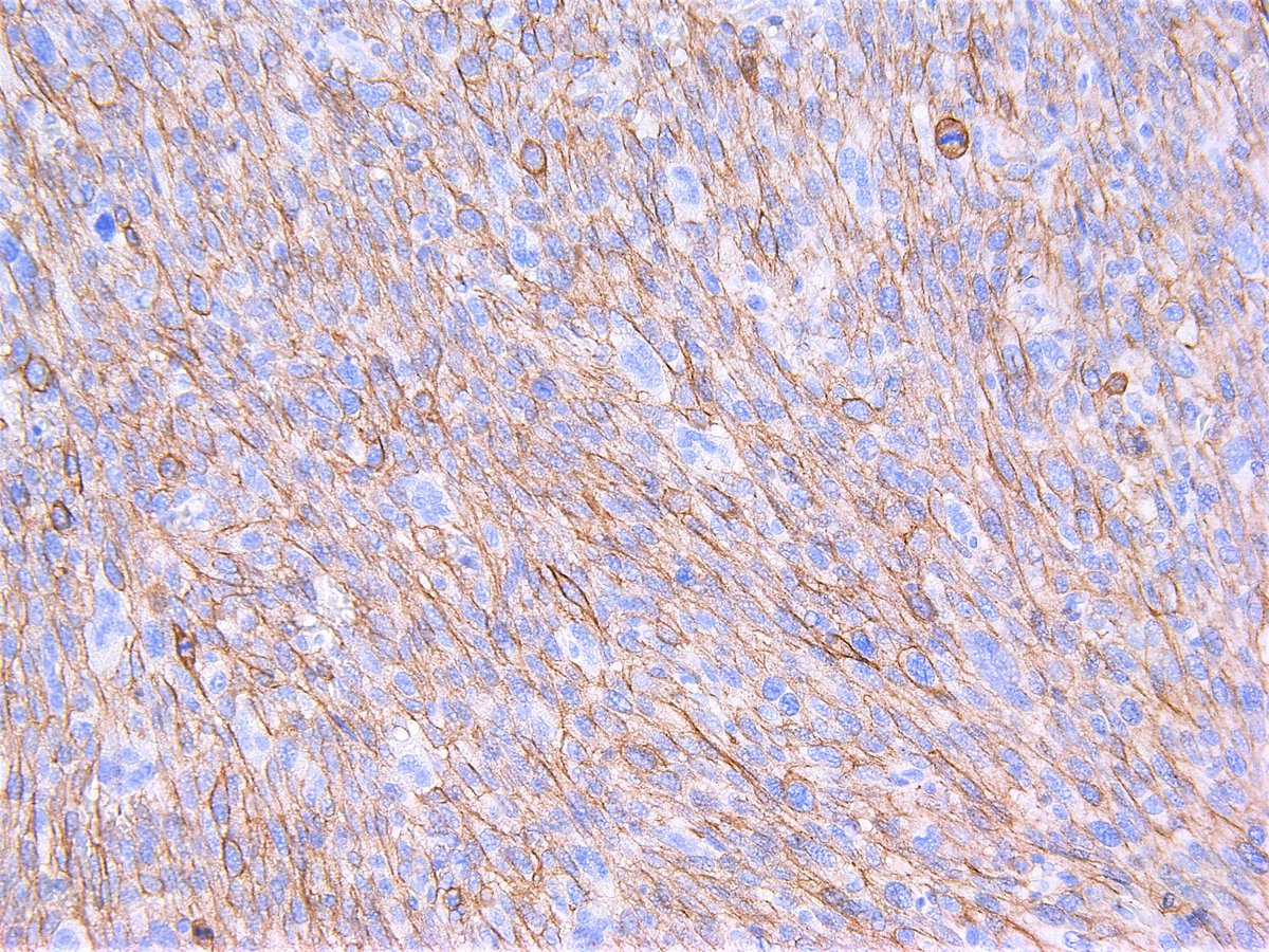 Patholwalker's tweet image. Leiomyosarcoma. Soft tissue, resection. HE and Caldesmon. #pathology #BSTpath