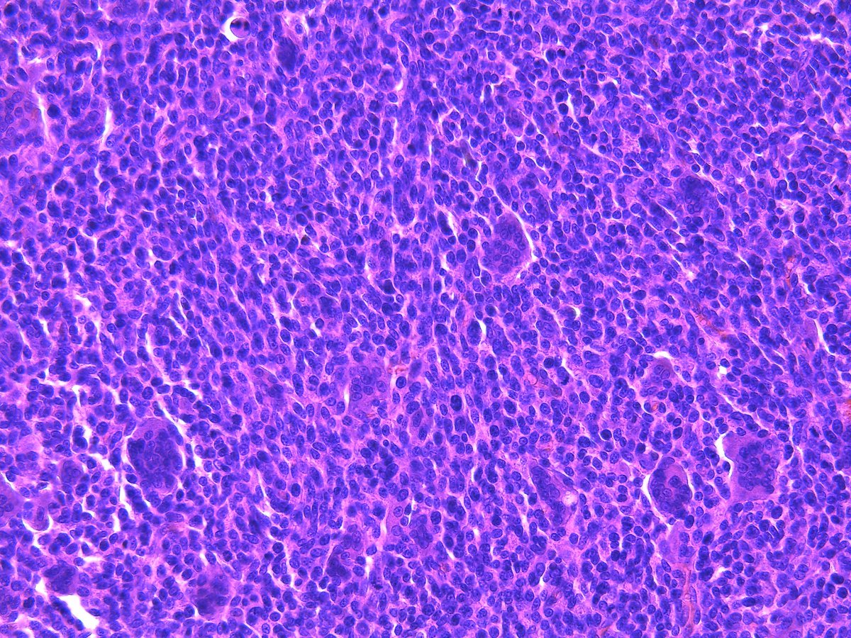 Patholwalker's tweet image. Leiomyosarcoma. Soft tissue, resection. HE and Caldesmon. #pathology #BSTpath