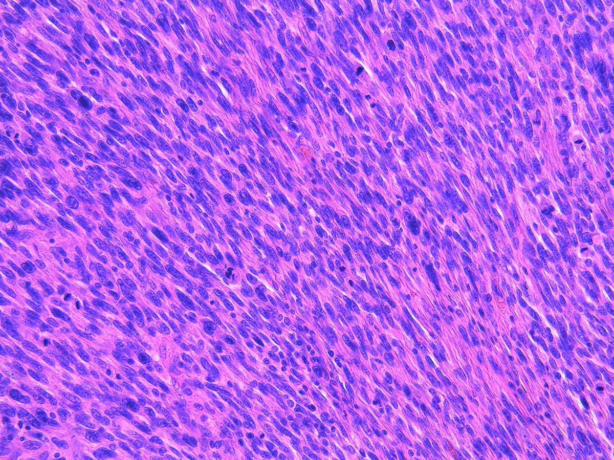Patholwalker's tweet image. Leiomyosarcoma. Soft tissue, resection. HE and Caldesmon. #pathology #BSTpath