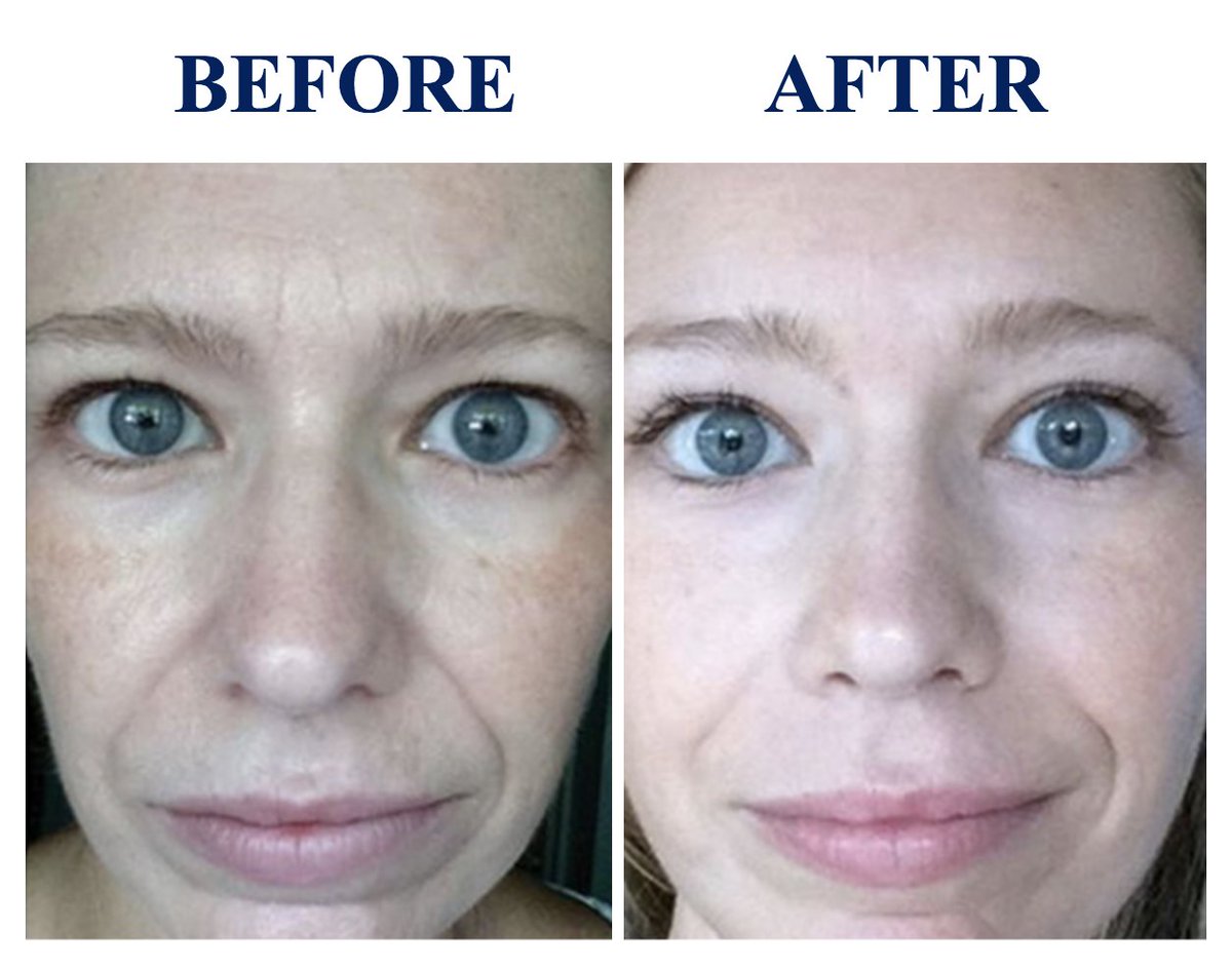 glutathione and vitamin c iv before and after Real Results: Before and After Photos at Celebrity Secrets main image 0