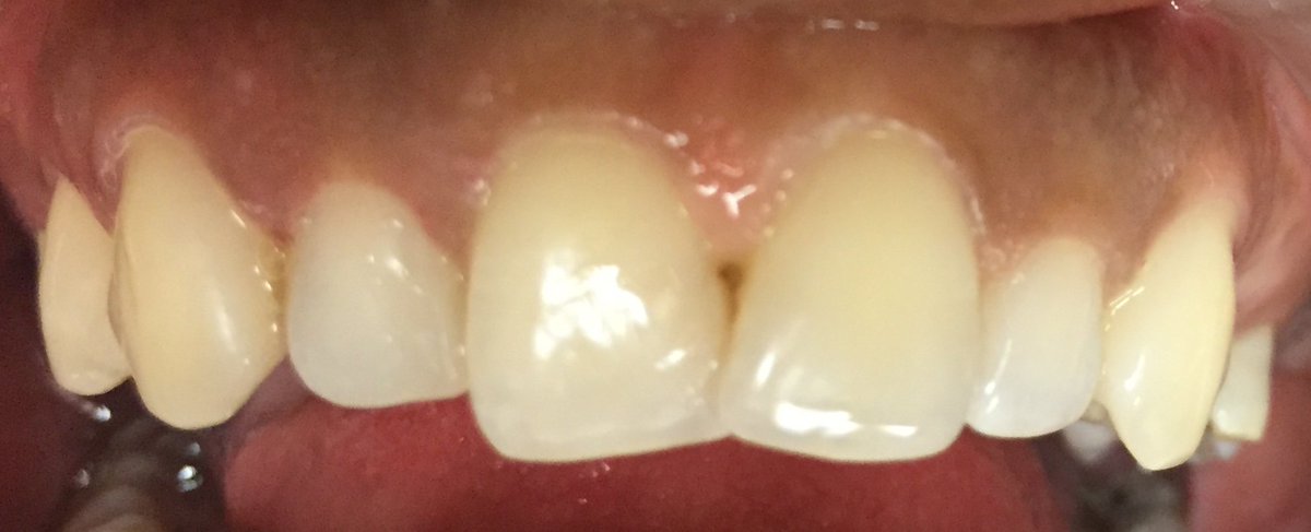 dentist_dibetso's tweet image. Research has proven that, significantly more plaque accumulates on malpositioned teeth compared with contralateral nonmalpositioned teeth. 
That leads to gum infection and dental decay. 
#dentalhygiene #dentistry #directcomposite #veneers #DentalHealth  #MondayMotivation #dentist