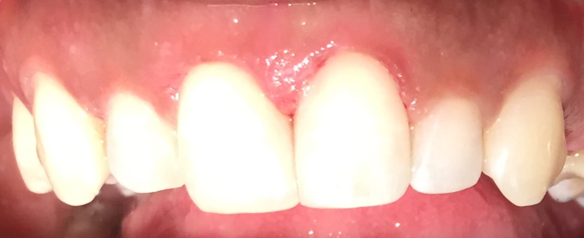 dentist_dibetso's tweet image. Research has proven that, significantly more plaque accumulates on malpositioned teeth compared with contralateral nonmalpositioned teeth. 
That leads to gum infection and dental decay. 
#dentalhygiene #dentistry #directcomposite #veneers #DentalHealth  #MondayMotivation #dentist