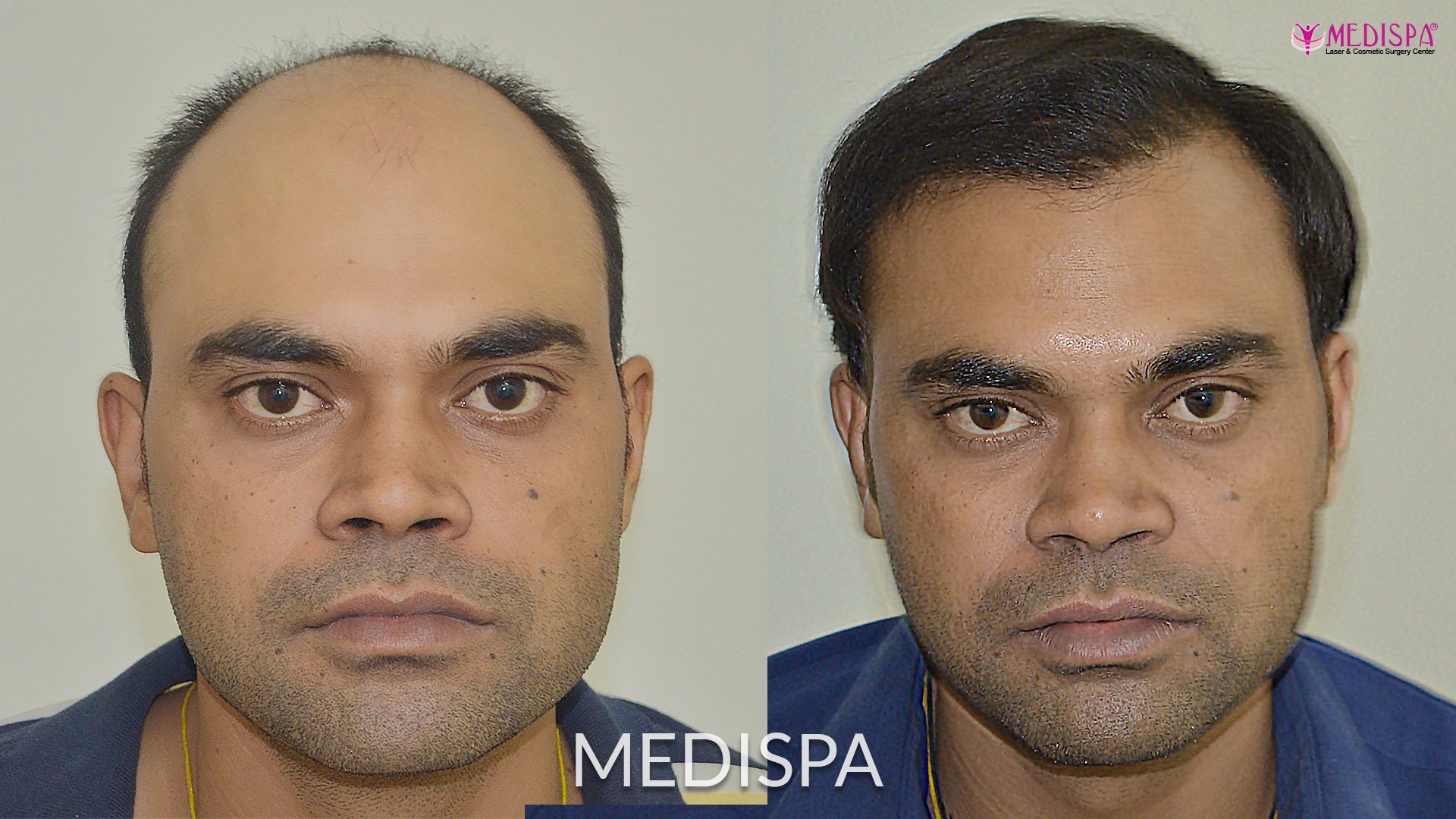 MedispaHairTransplantCenter on Twitter: MedispaHairTransplantCenter on Twitter: