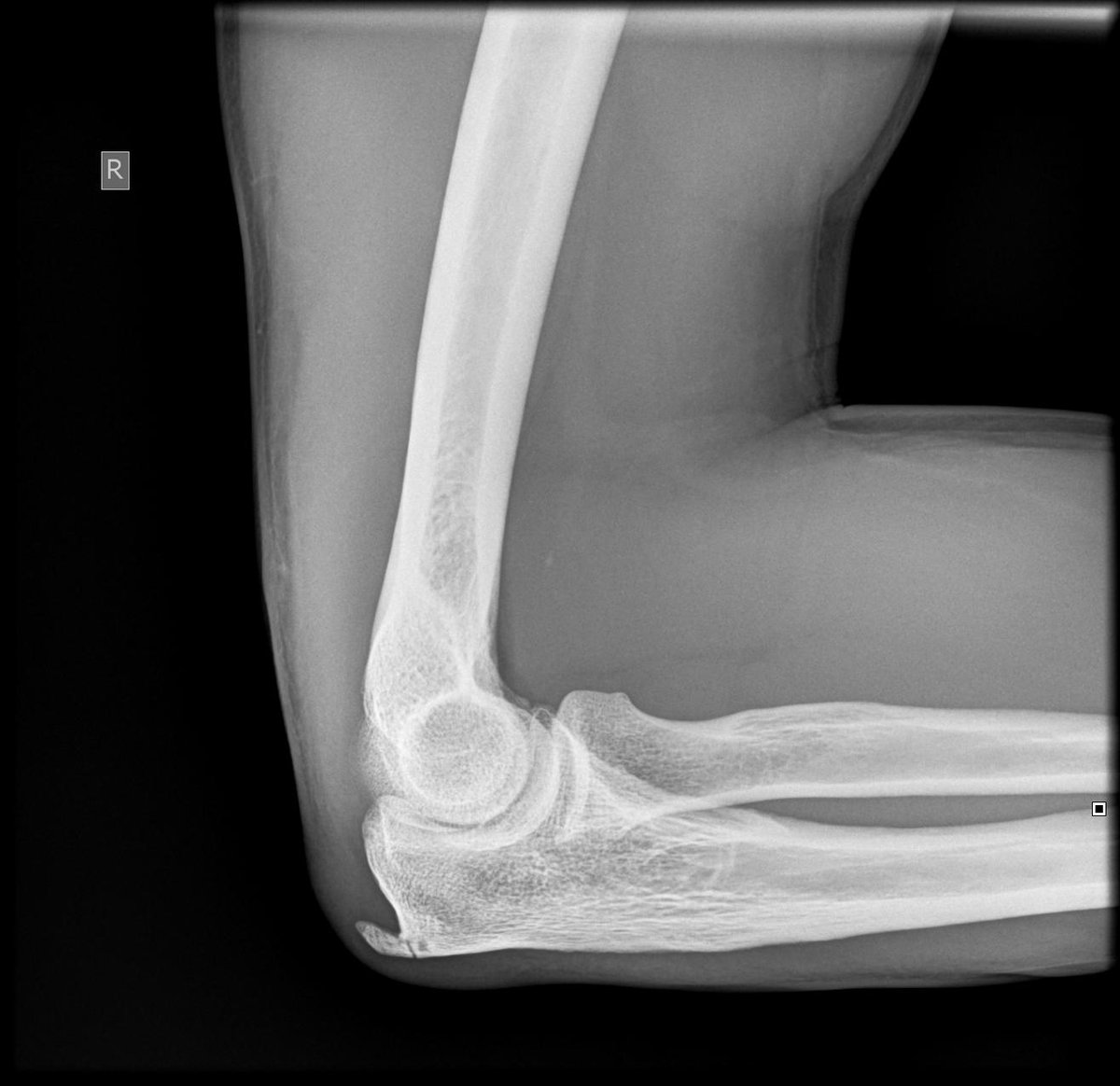 A fractured elbow.