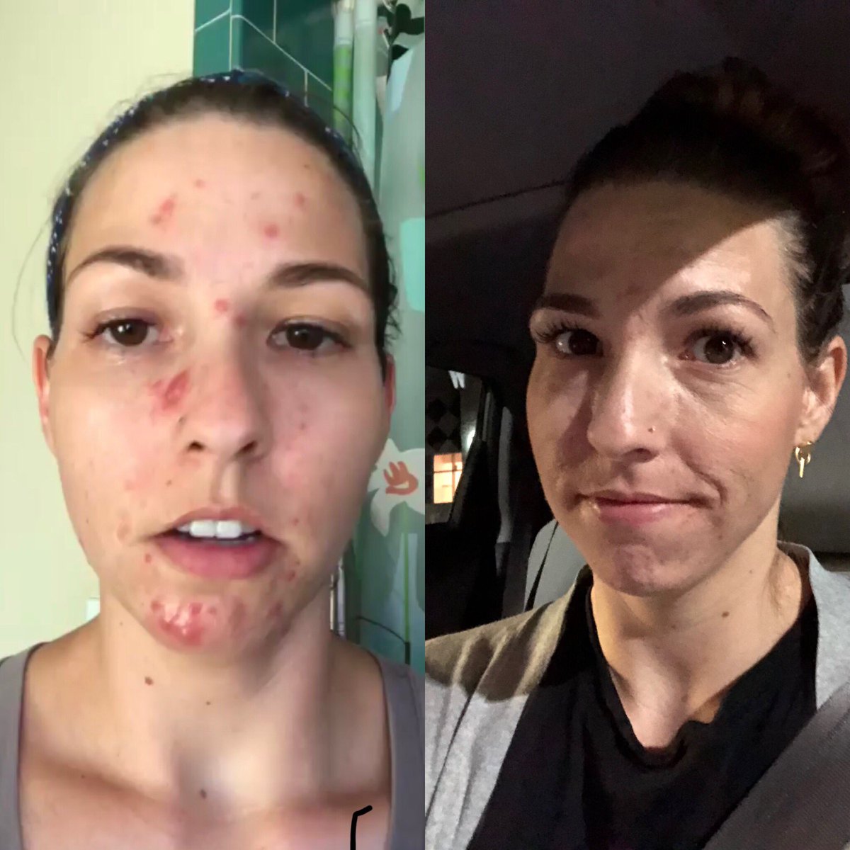 dnpcorso's tweet photo. From this to that. @glossier products do work. #superpure #thankyou #cysticacne #always #problemsinceiwas16 https://t.co/zgXhnlIkJF