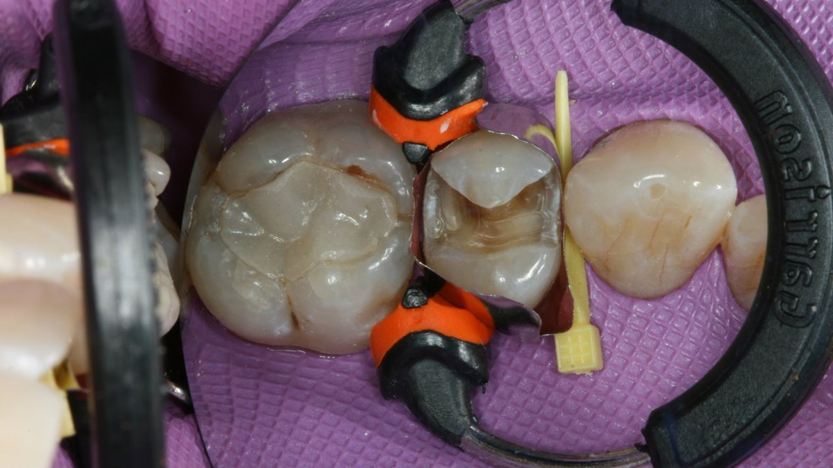 DPR_Magazine's tweet photo. [Sponsored] Designed to deliver superior esthetics and perfect adaptation with one quick 20-second light cure, Ecosite Bulk Fill is the new generation of bulk fill composites for all your posterior restorations. #dmgamerica #EcositeBulkFill Learn more: https://t.co/RMXYNiLamy https://t.co/4nTAhvVsXW