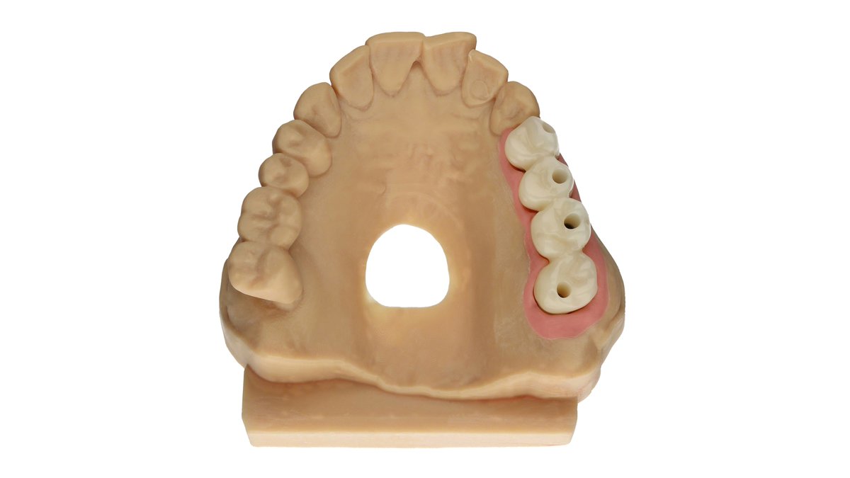 ZinserDental's tweet photo. 😍 Impressionen eines PV's Teil 1/3 😍
Implantologie + intraoraler Scan + 3D-Druck + CAD/CAM + handwerkliche Leidenschaft = ein weiteres Sofortprovisorium für einen zufriedenen Kunden.
#Straumann #Zirkonzahn #CADCAM #Trios3 https://t.co/NarEWokXjb