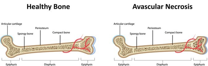CliniNephrology's tweet photo. #Interesting Avascular Necrosis and Immunosuppression; A Management Dilemma
Get to know @ https://t.co/fmkFpPXvdi https://t.co/SPukSXb2bv