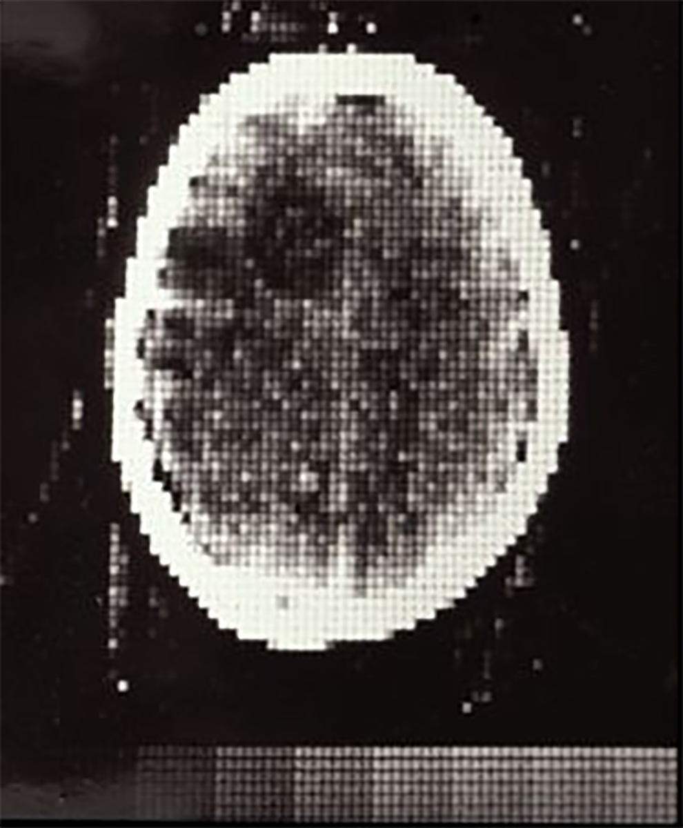 ARRS_Radiology's tweet photo. The first CT scan of a patient's brain was taken on this day in 1971. https://t.co/pgncVIxKWw