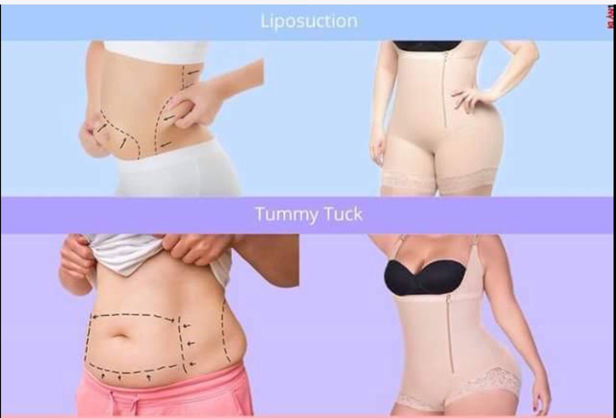 curveitup's tweet photo. Why use compression garment after liposuction? https://t.co/YnWFx858f6