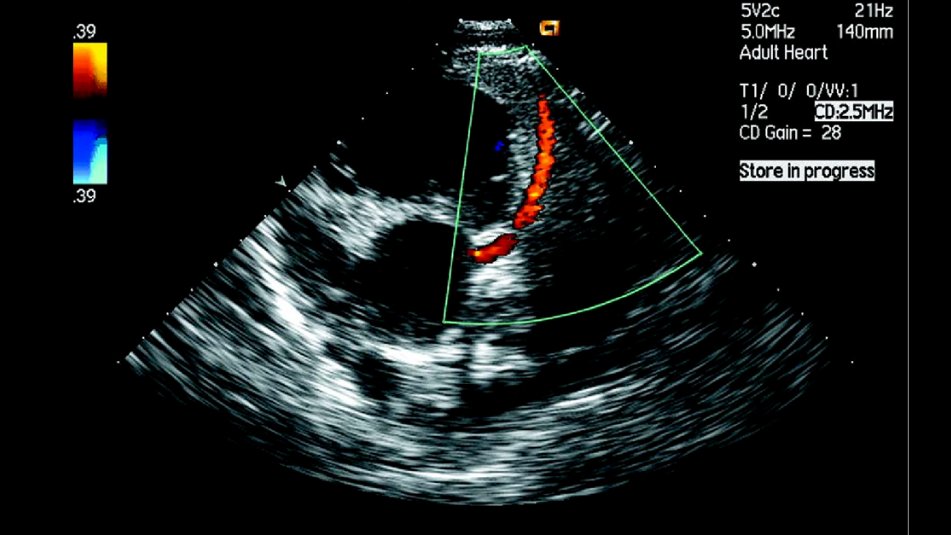 #Coronarymicrovasculardysfunction (#CMD) was highly prevalent in #heartfailurewithpreservedejectionfraction (#HFpEF), according to an #echocardiographicstudy. The findings add to growing evidence that CMD could be targeted for HFpEF #therapy:  qoo.ly/sesq7