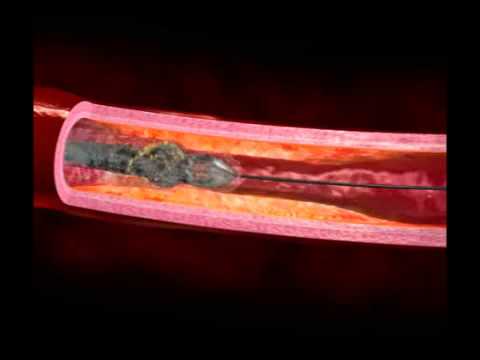 CRMjournal's tweet photo. Outcomes of #rotationalatherectomy in #patients with severe #leftventriculardysfunction without #hemodynamicsupport by Hoyle L. Whiteside, @sratanapo et al. in September issue https://t.co/OnpXfU293v https://t.co/O7mpTrh9ST