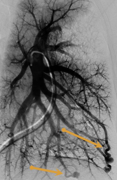RajWellnessMD's tweet photo. Patient with #HHT with pulmonary AVM.  Classic history of epistaxis, mucocutaneous telangiectasias, and 1st degree relative.  Successfully treated with coil embolization.  #irad @JVIRmedia @SIRspecialists @ChrisDMaloneVIR @SIRRFS @CVIR_Journal https://t.co/v1me60Yzfb