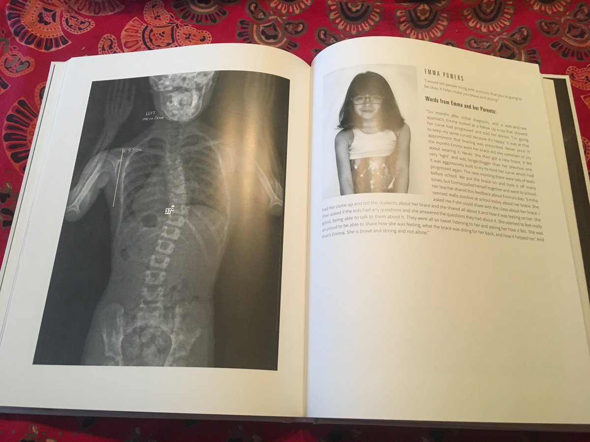 beFited's tweet photo. At @beFited, we are inspired with the bravery, courage, &amp; artistic ability of #SyndeeLubar telling her &amp; 28 other #scoliosis warriors stories in her elegant book #Spines to benefit #nationalscoliosisfoundation non-profit founded by #JoeOBrien.  Get yours: https://t.co/nwSve7hEZA https://t.co/FSbdFeT4of