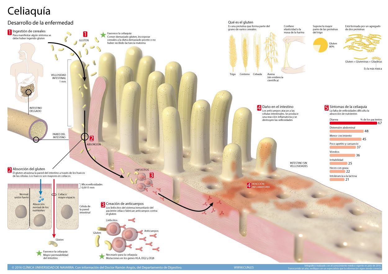 La enfermedad celiaca no es una alergia ni una intolerancia #microMOOCCA2
Se trata de una respuesta inmune específica dirigida contra el epitelio intestinal. Es más compleja, probablemente autoinmune desencadenada por la presencia de gluten en el intestino provoca su inflamación https://t.co/XlHzvNwxFQ